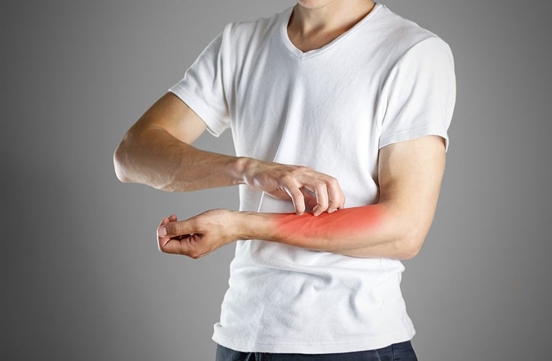 Flea bite symptoms in humans