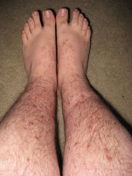 flea bites legs feet