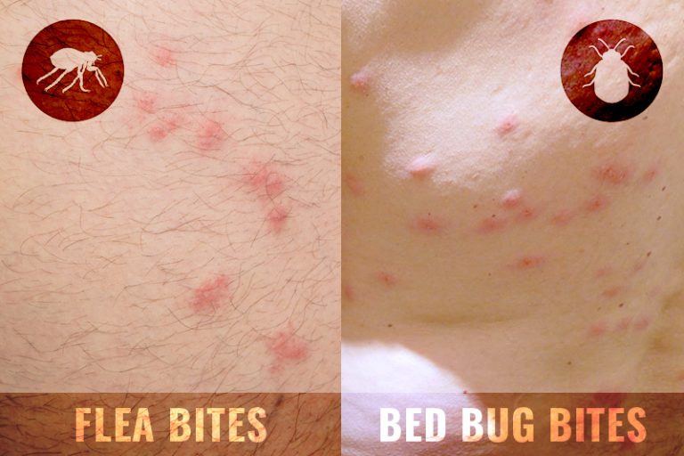 flea bite vs bed bug bite