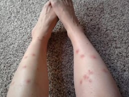 Flea Bites on Legs