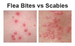 Flea Bites vs Scabies - How Are They Different?