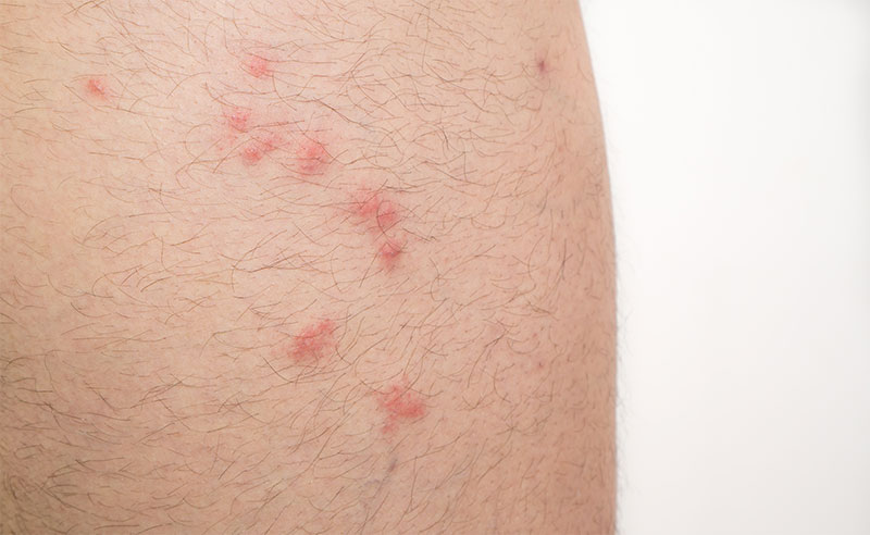 Flea Bites On Humans Pictures Treatment And Prevention