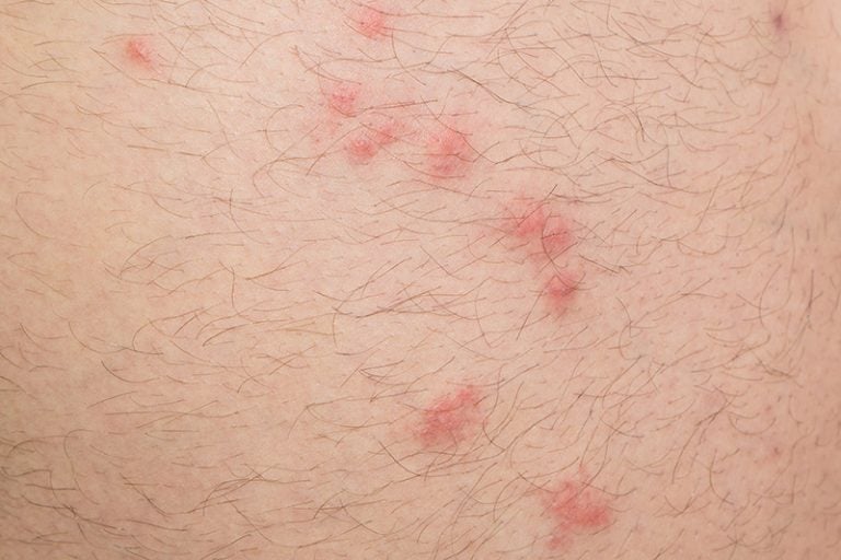Human Fleas Pulex Irritans Bites FLEABITES